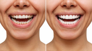 What are Porcelain Veneers and How Can They Improve My Smile?